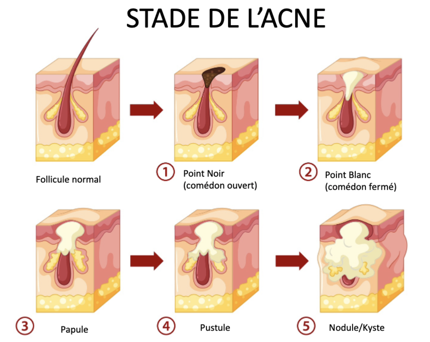 Schéma des différents stades de l’acné, de légère à sévère