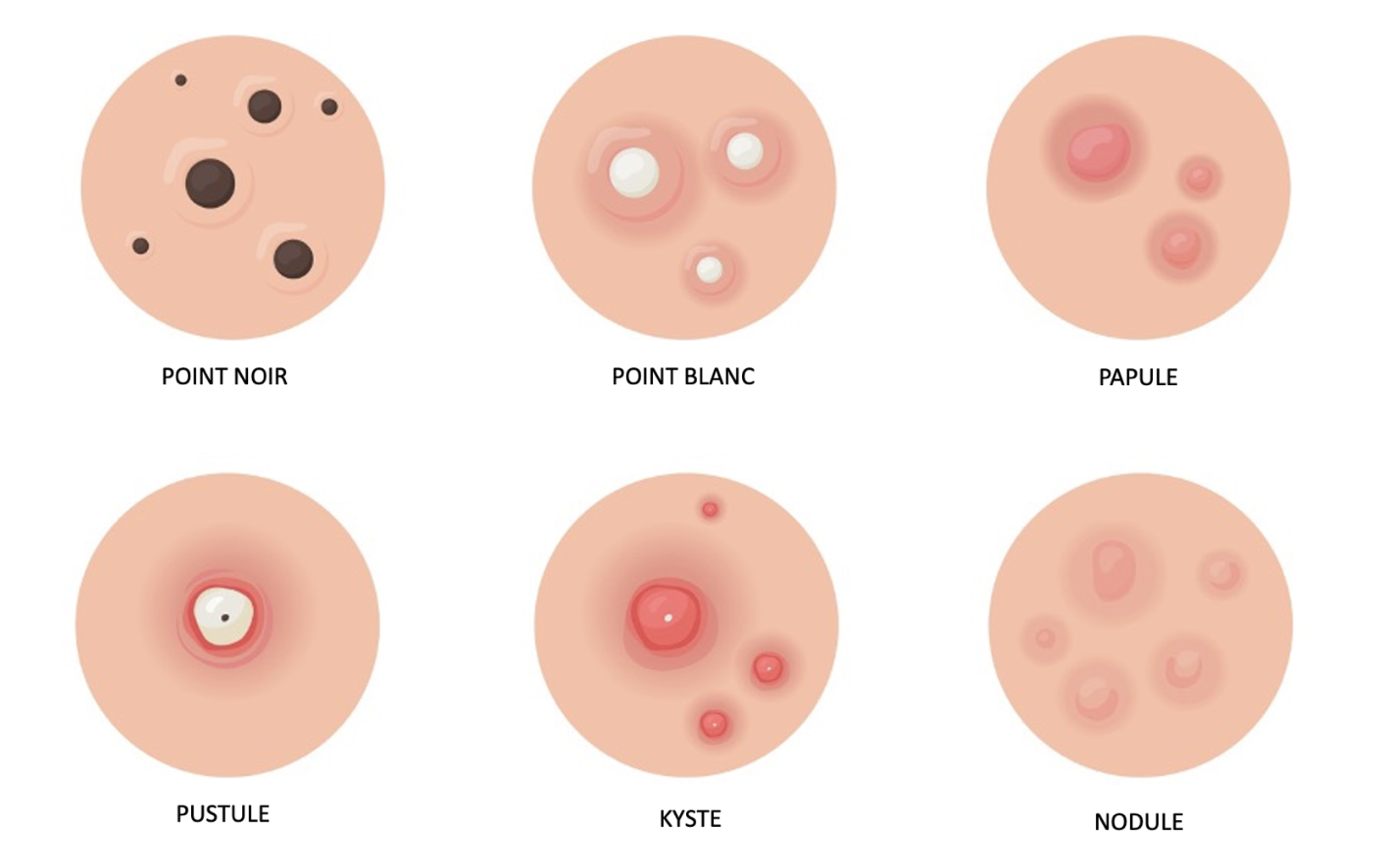 Visuel montrant les différents types de boutons : points noirs, blancs, papules, pustules, nodules, kystes