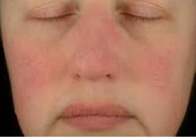Une personne atteinte de Rosacée Érythémato-télangiectasique
