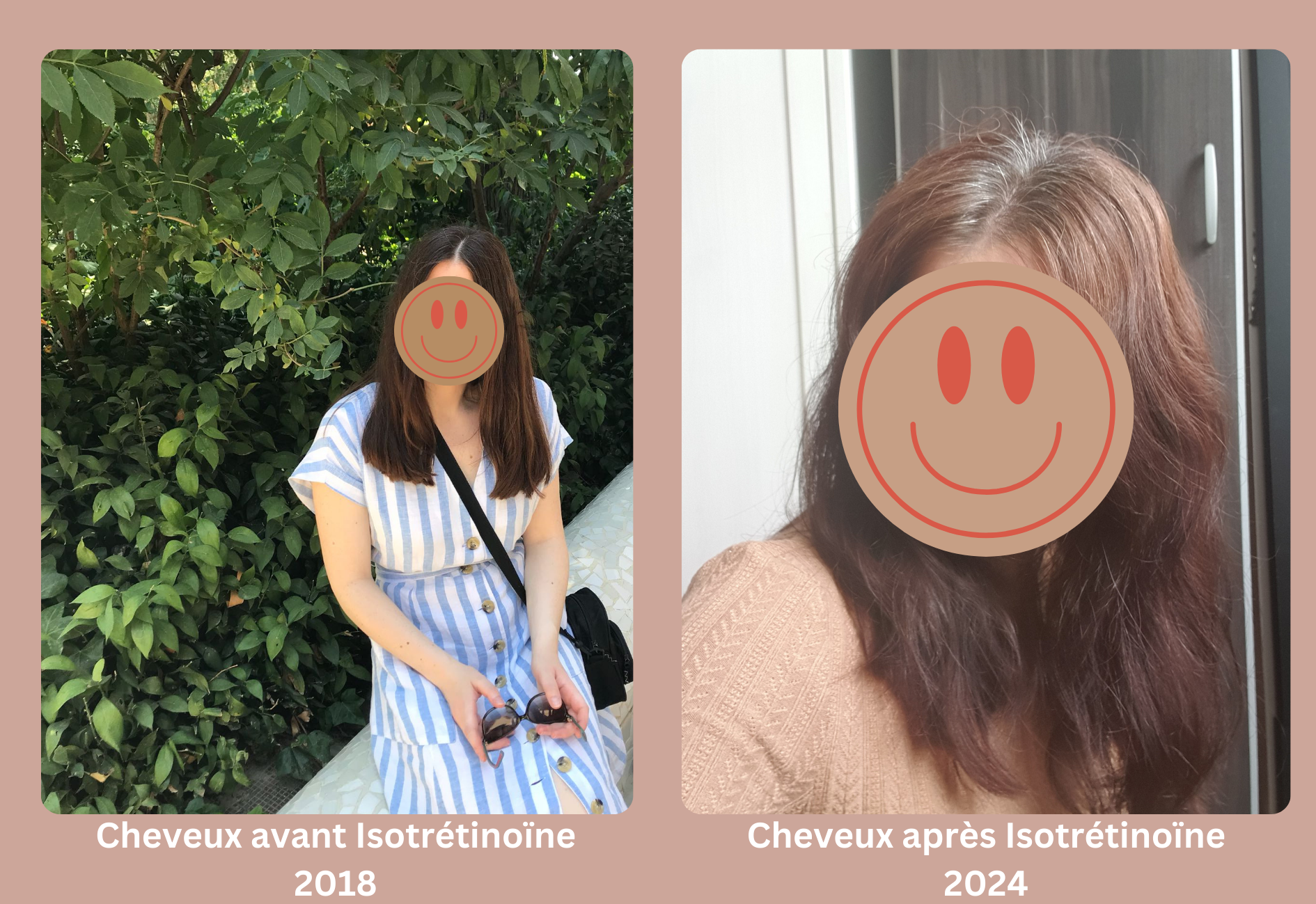 Avant et après mes cheveux, 2018 vs 2024 après traitement Roaccutane