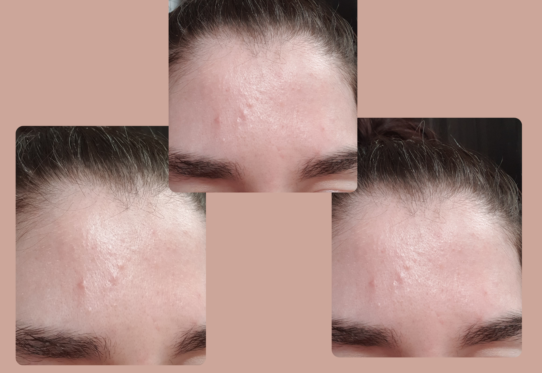 Photo de mon front juste après avoir utilisé l'urée et la trétinoïne ensemble