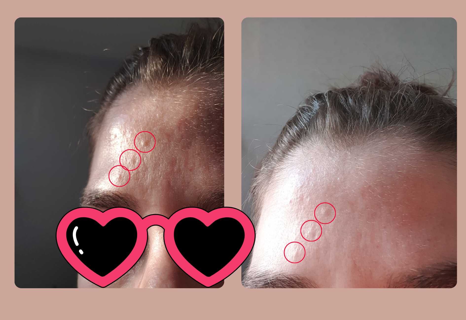 Mon hypoplasie sébacée sur le front