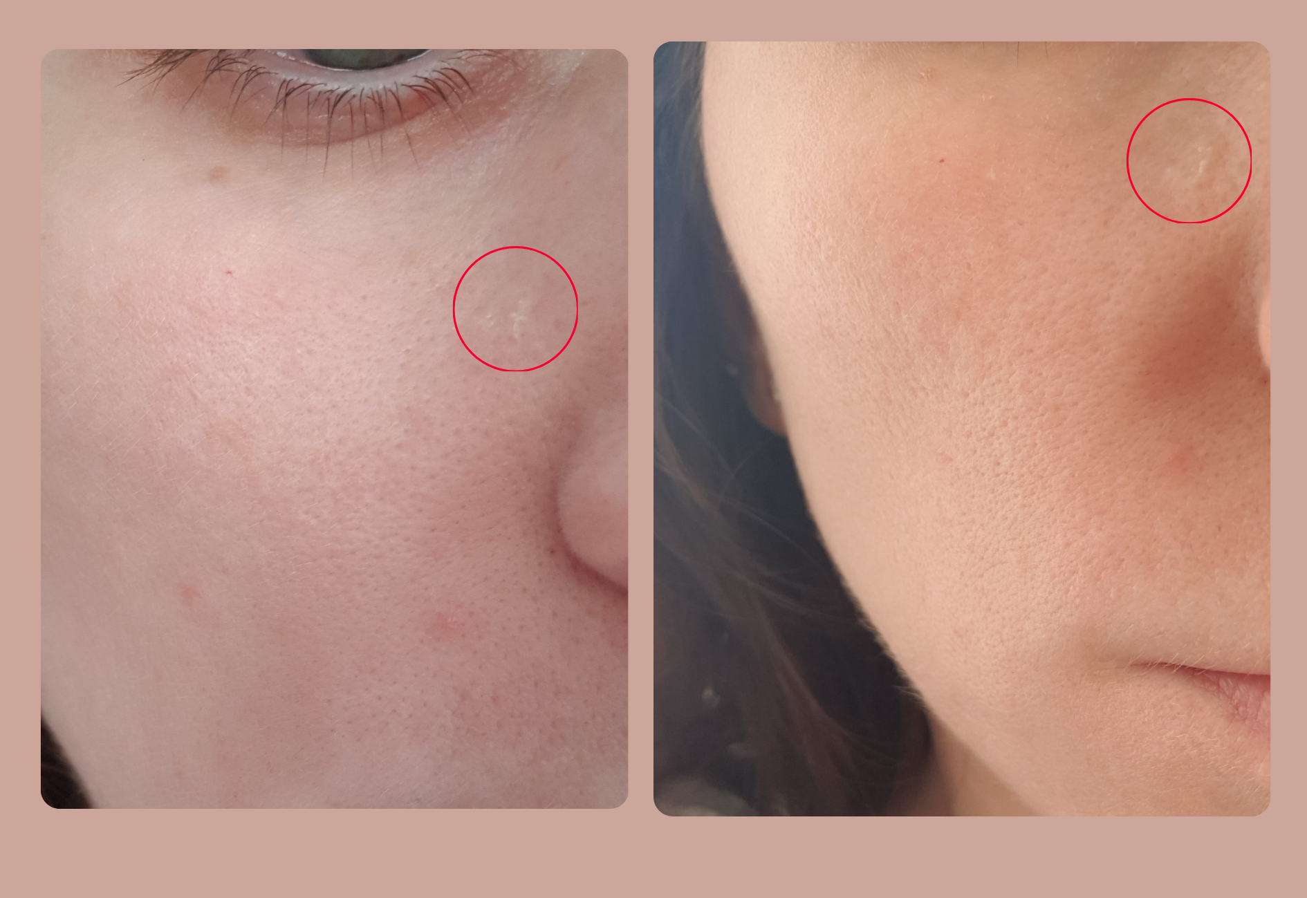 Hypoplasie sébacée à côté de mon nez