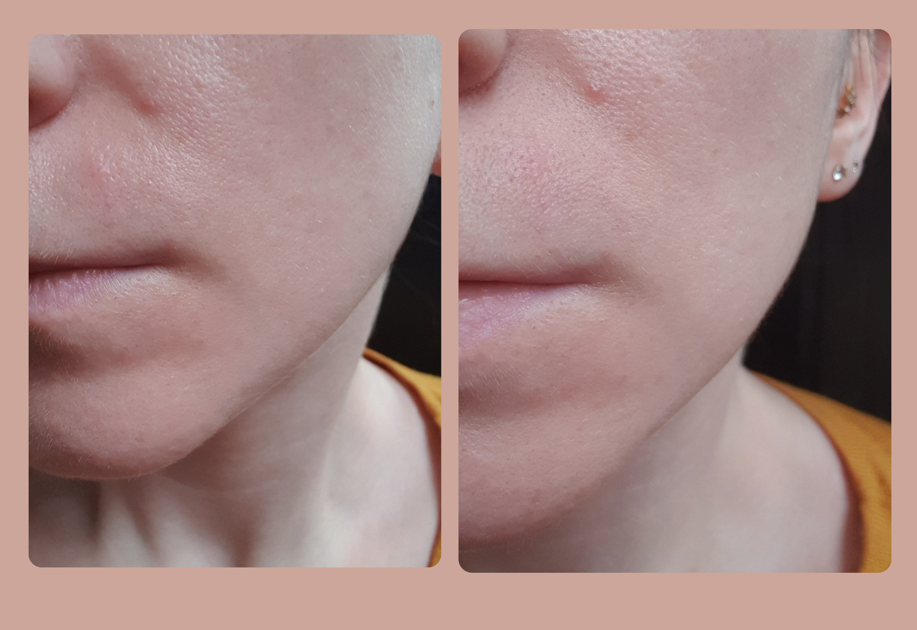 Ma peau après l'utilisation de l'urée et de la trétinoïne, avec une meilleure lumière