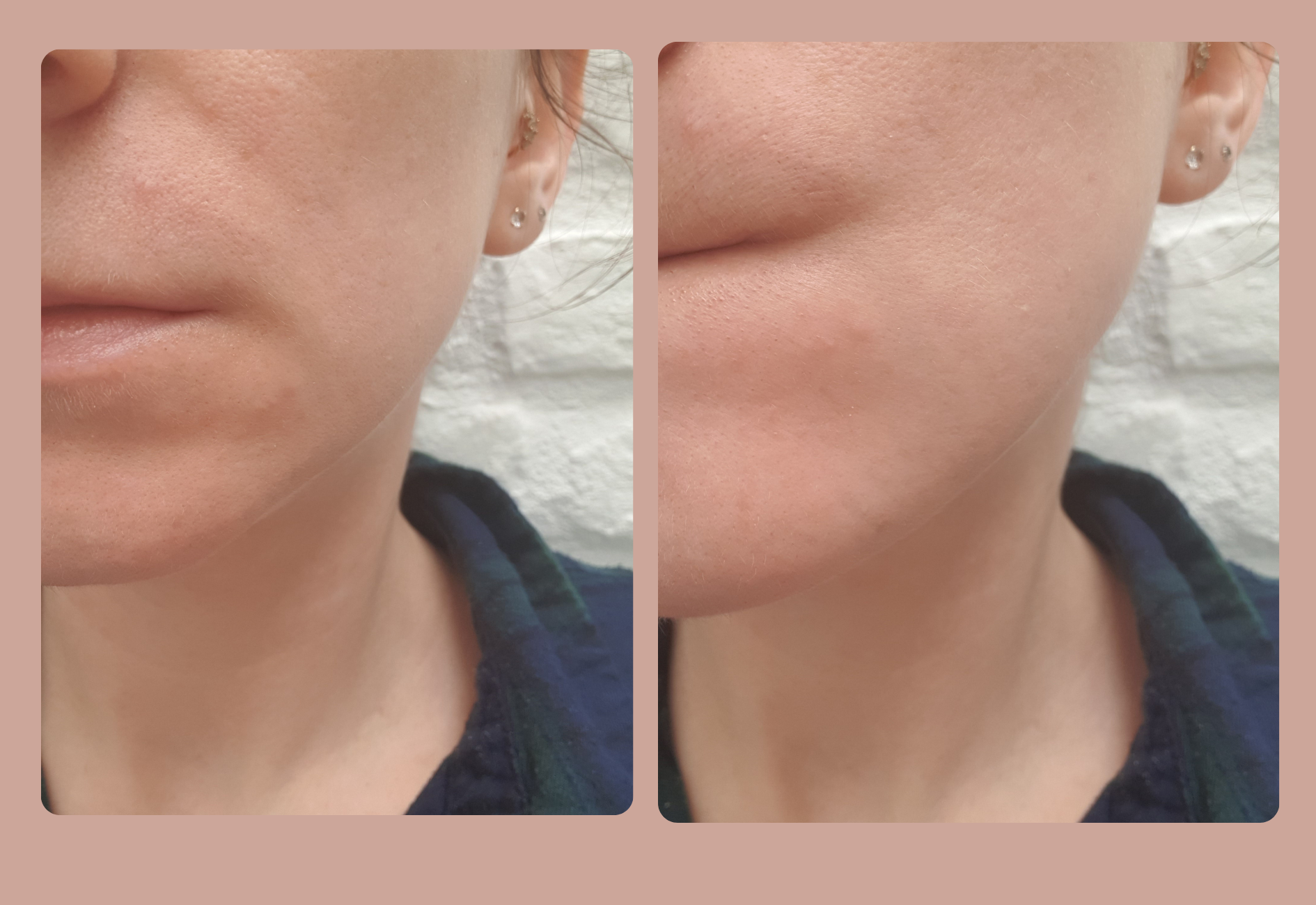 Ma peau après l'utilisation de l'urée et de la trétinoïne ensemble