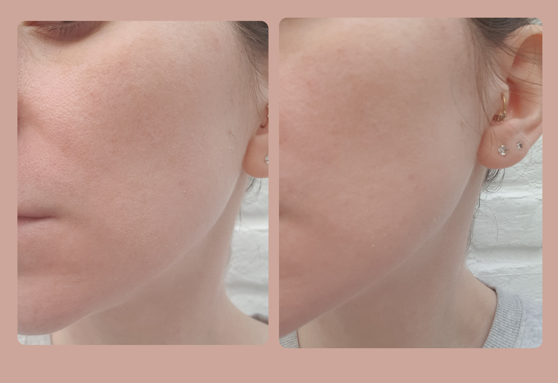 Ma peau avant l'utilisation de l'urée et de la trétinoïne ensemble