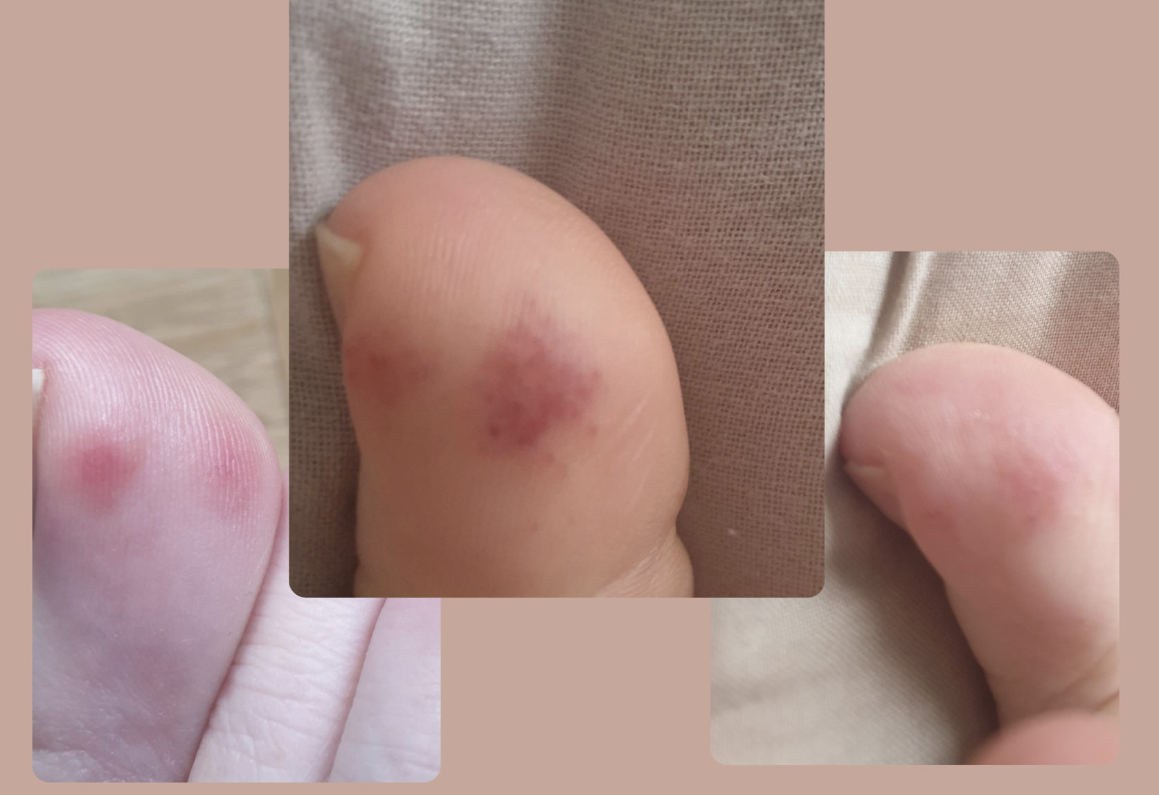 Engelures sur mes pieds - montrant rougeur et gonflement