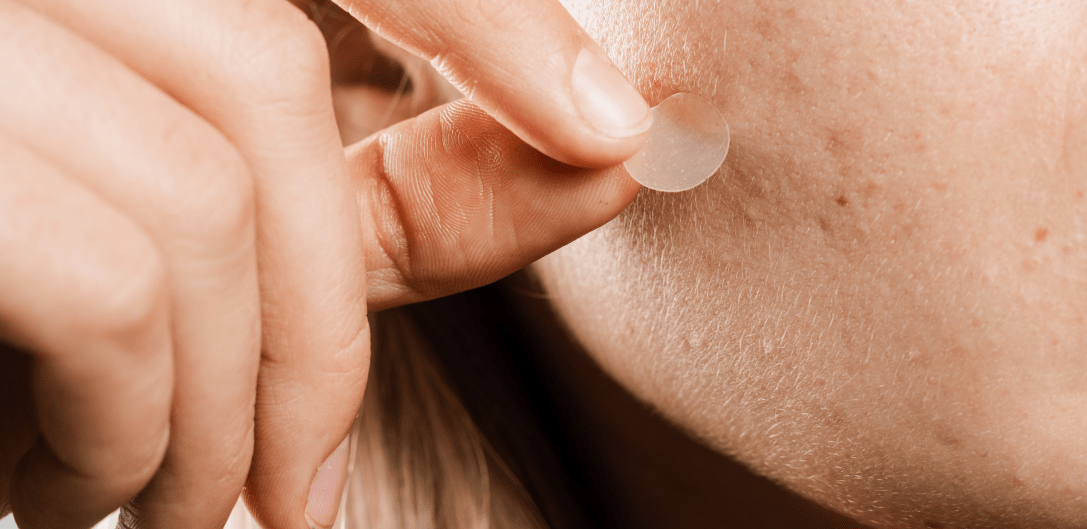 Image de couverture de mon article sur les patchs anti-acné