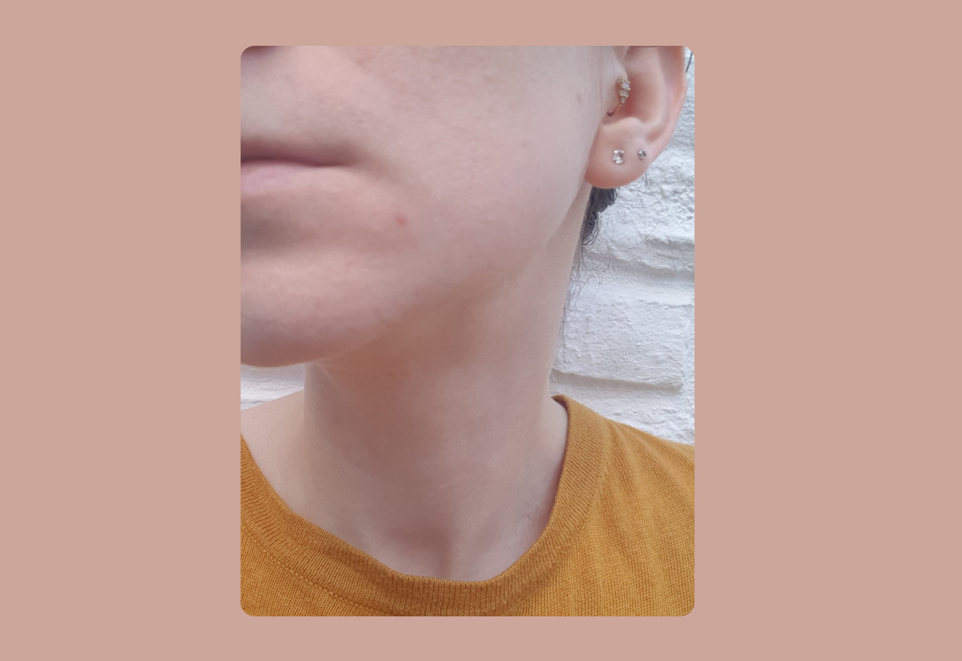 Évolution du bouton après trois jours avec le patch SOME BY MI