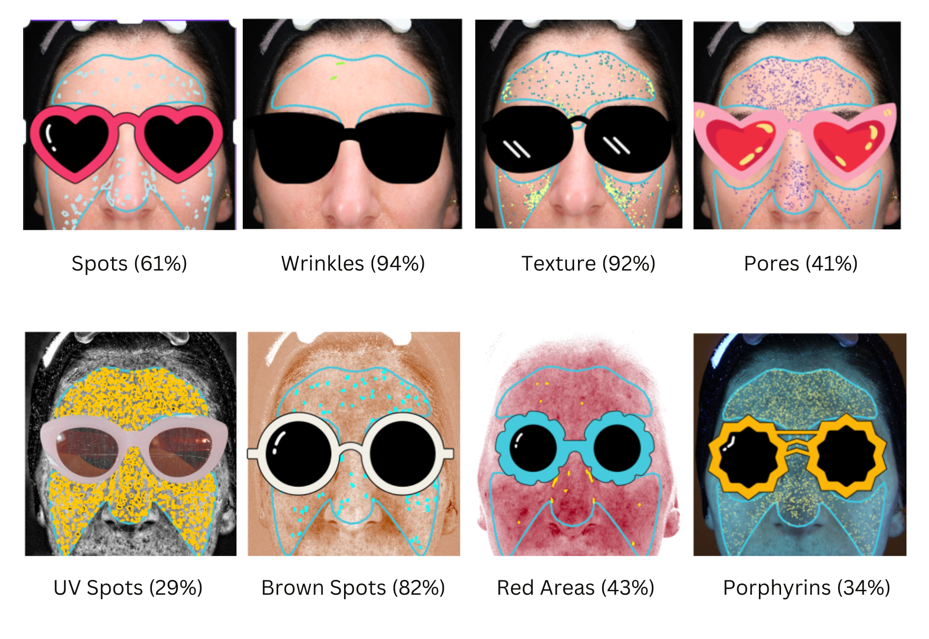 Résultats de l'analyse faciale Visia montrant les mesures et les conditions de la peau