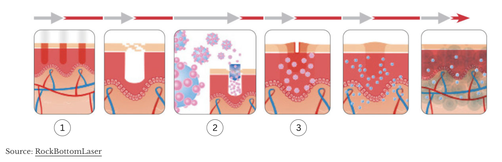 Illustration du fonctionnement de LaseMD, créant des micro-canaux dans la peau pour une pénétration profonde des sérums