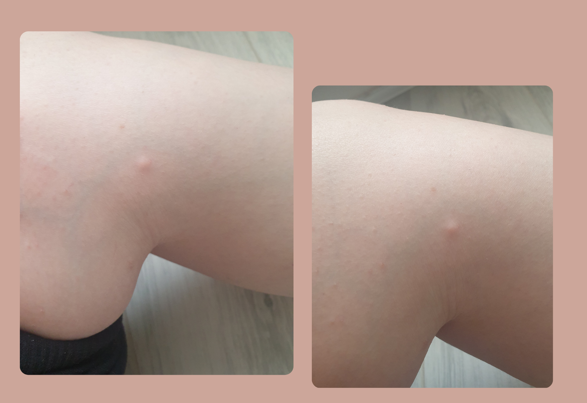 Dermatofibrome à la jambe vu sous le premier angle