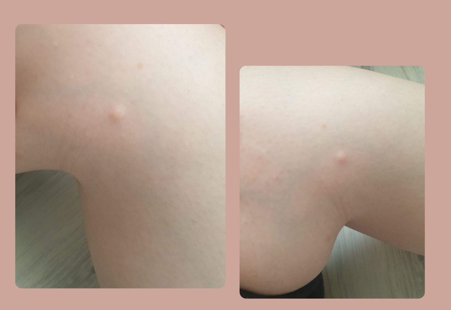 Dermatofibrome à la jambe vu sous le second angle