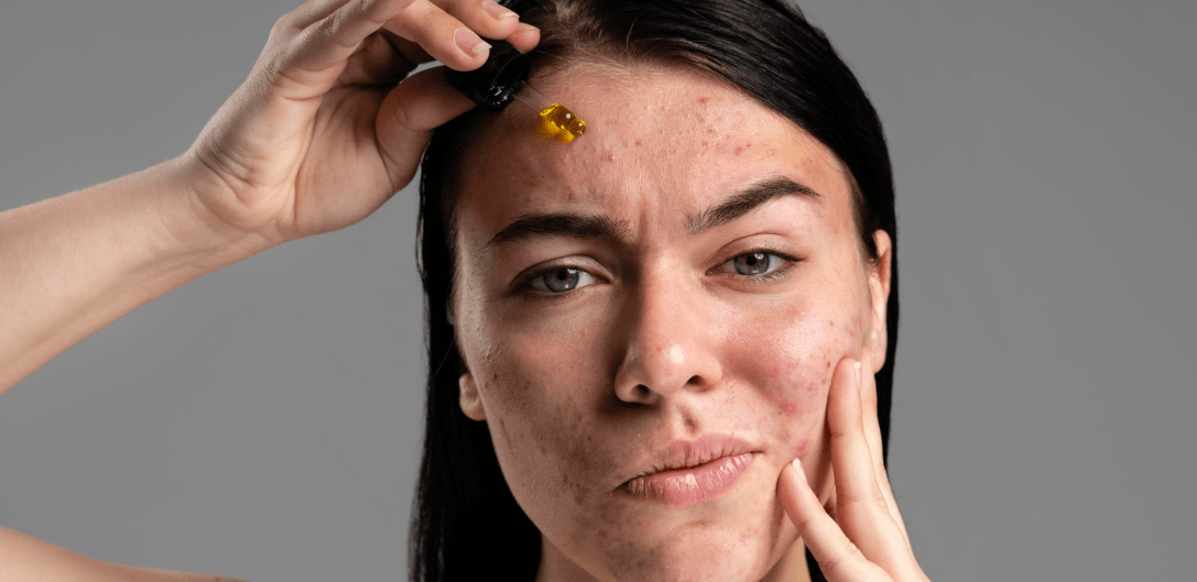 couverture-photo-article-purge-apres-une-pause-skincare