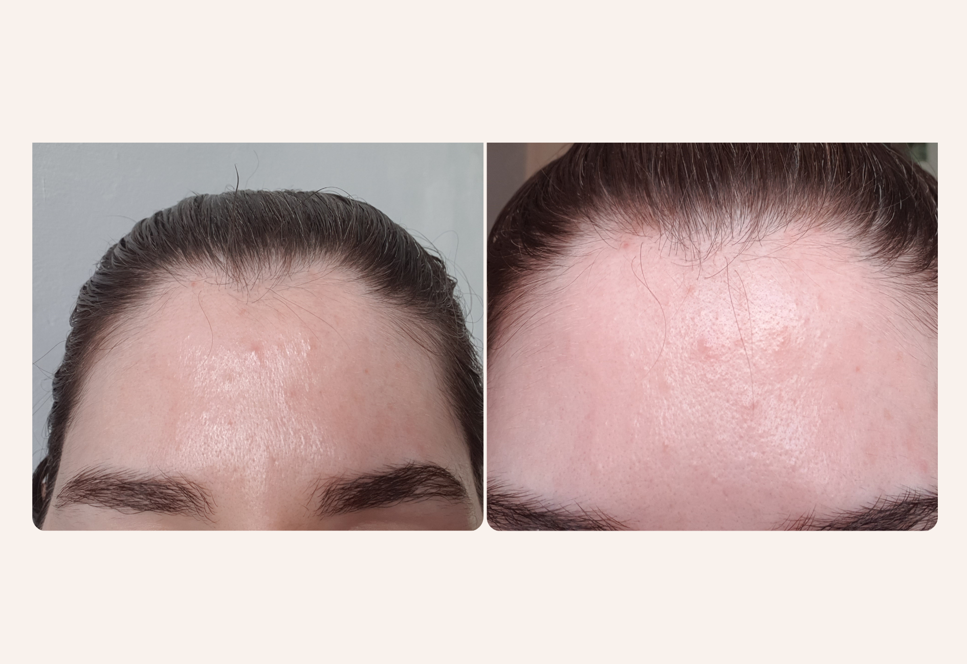 Photo de mon front montrant ma purge après ma pause skincare - trétinoïne et acide azélaïque