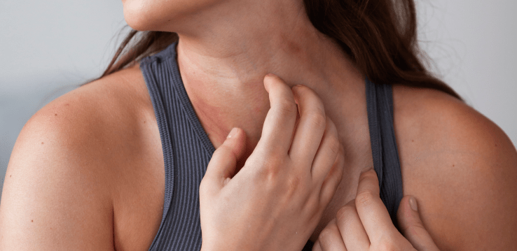 Trétinoïne sur le cou: mon expérience et les effets secondaires (eczéma &&nbsp;irritation)