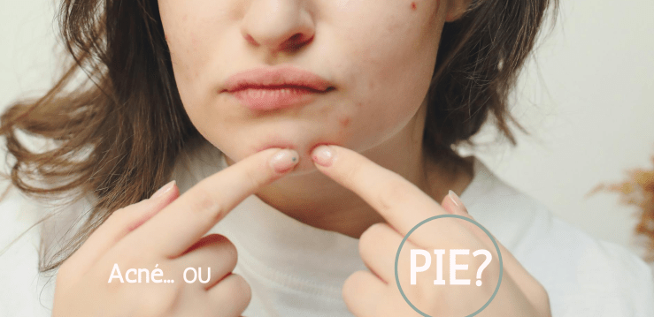 Rougeurs sur le visage: acné ou PIE&nbsp;?