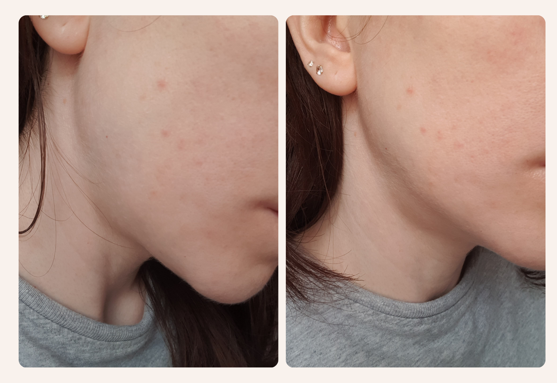 Comment le PIE apparaît sur peau claire (la mienne)